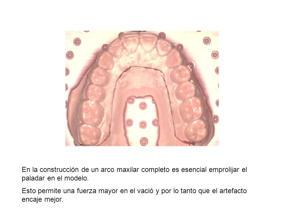 En la construcción de un arco maxilar completo es esencial emprolijar el paladar en el modelo.