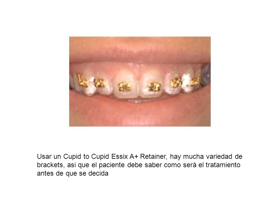 Usar un Cupid to Cupid Essix A+ Retainer, hay mucha variedad de brackets, asi que el paciente debe saber como será el tratamiento antes de que se decida