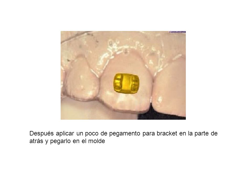 Después aplicar un poco de pegamento para bracket en la parte de atrás y pegarlo en el molde