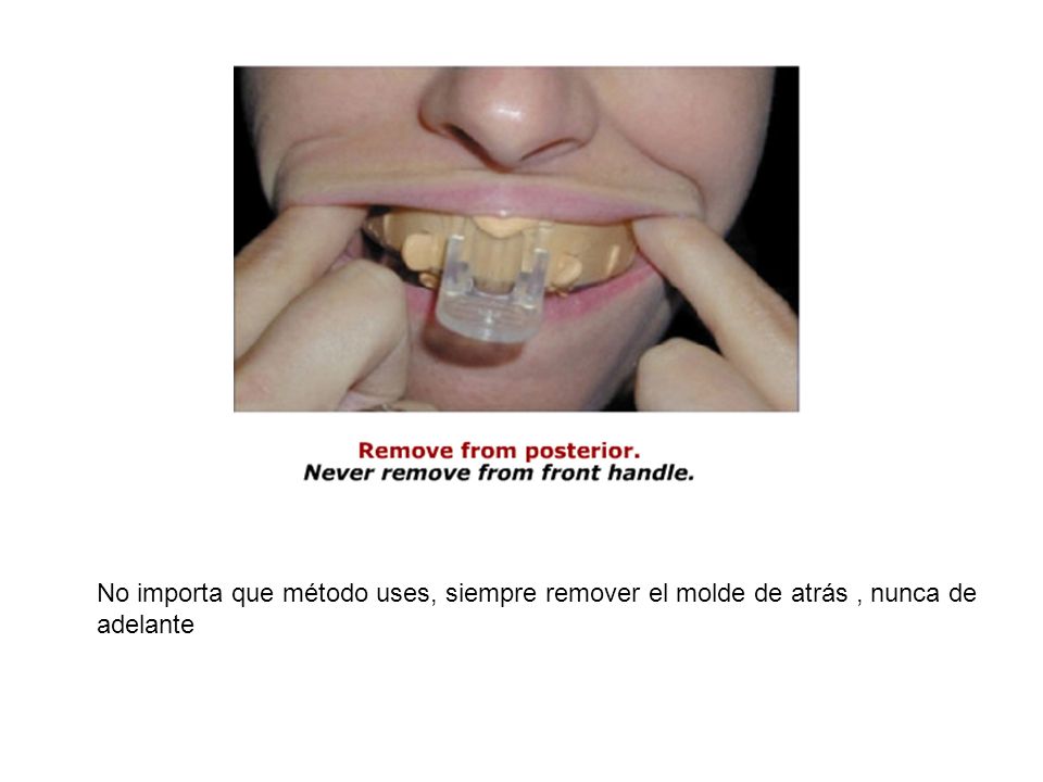 No importa que método uses, siempre remover el molde de atrás , nunca de adelante