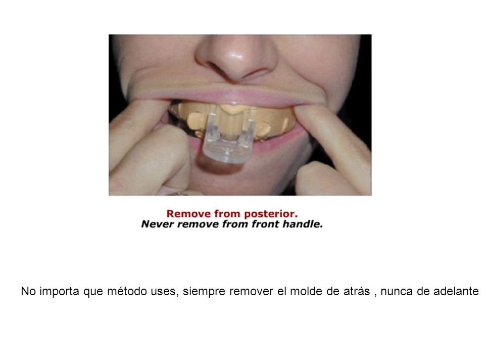 No importa que método uses, siempre remover el molde de atrás , nunca de adelante