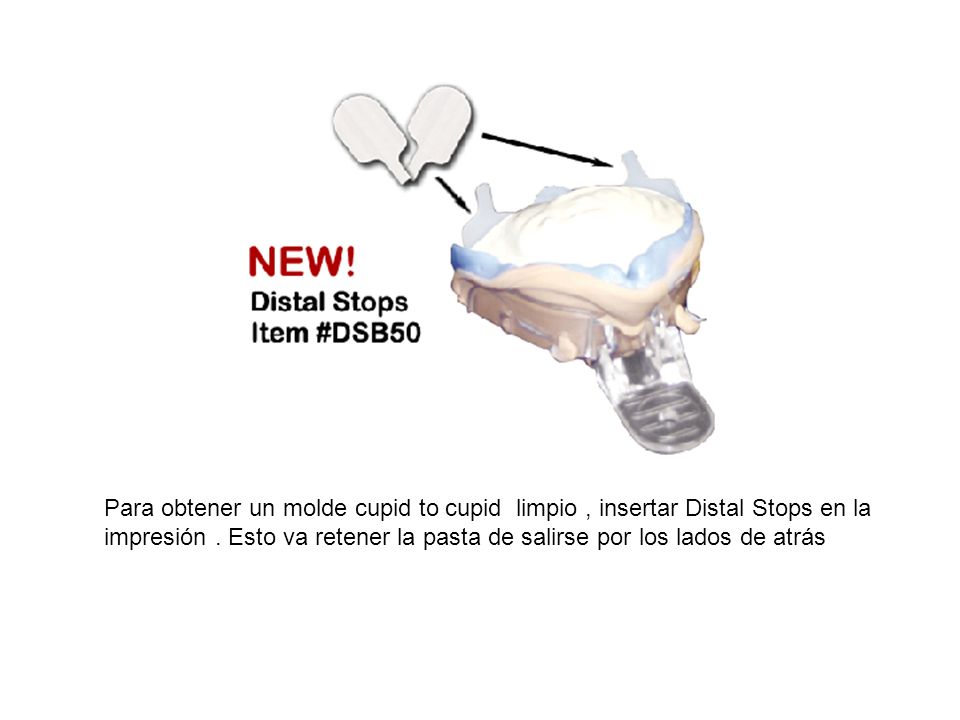 Para obtener un molde cupid to cupid limpio , insertar Distal Stops en la impresión .