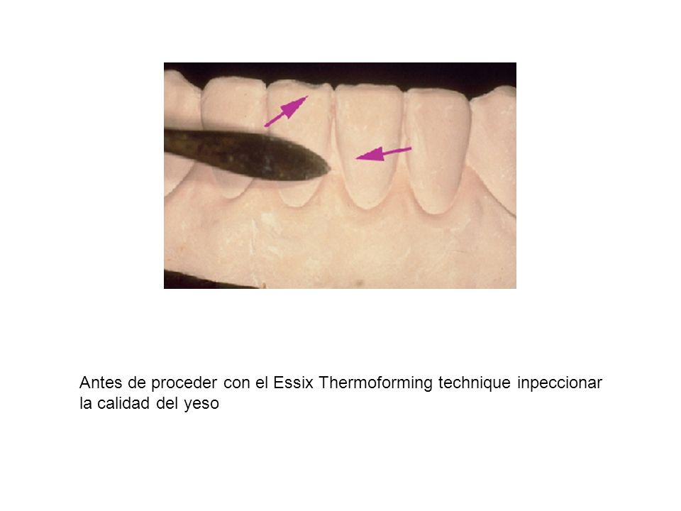 Antes de proceder con el Essix Thermoforming technique inpeccionar la calidad del yeso