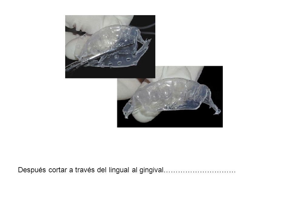 Después cortar a través del lingual al gingival…………………………
