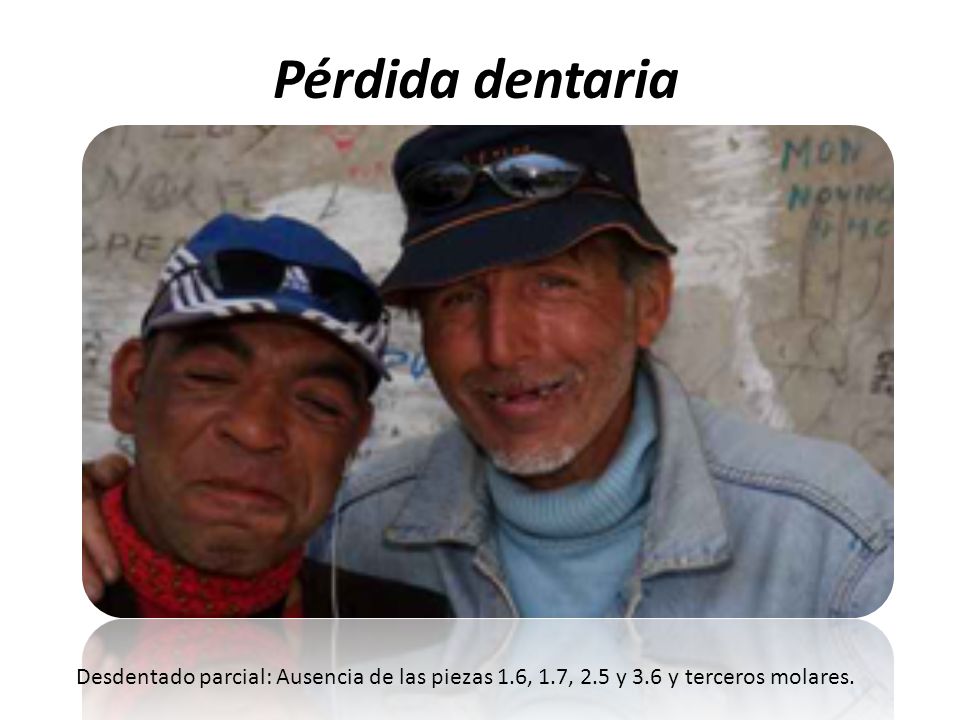 Pérdida dentaria Desdentado parcial: Ausencia de las piezas 1.6, 1.7, 2.5 y 3.6 y terceros molares.