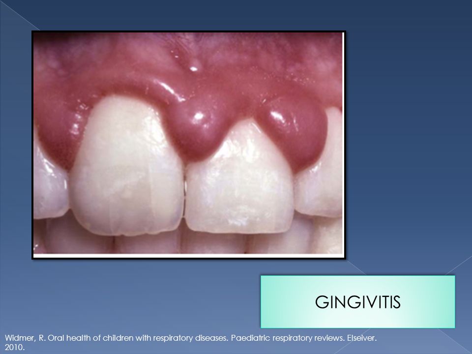 GINGIVITIS Widmer, R. Oral health of children with respiratory diseases.