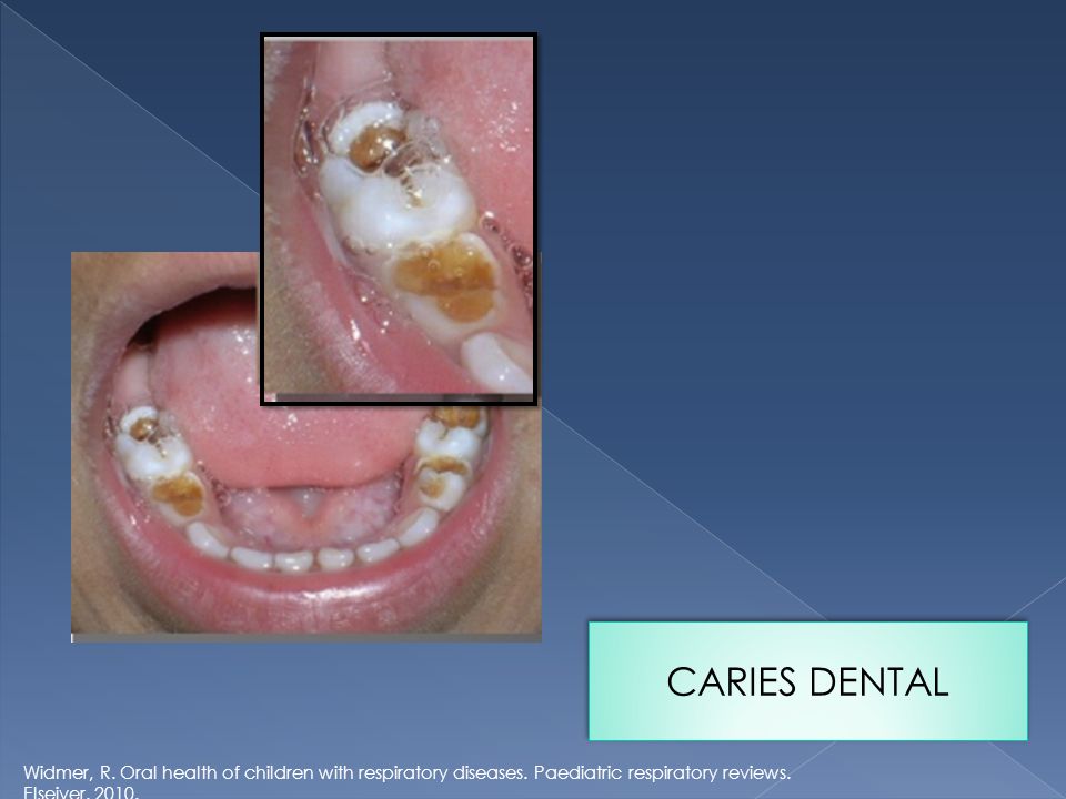 CARIES DENTAL Widmer, R. Oral health of children with respiratory diseases.