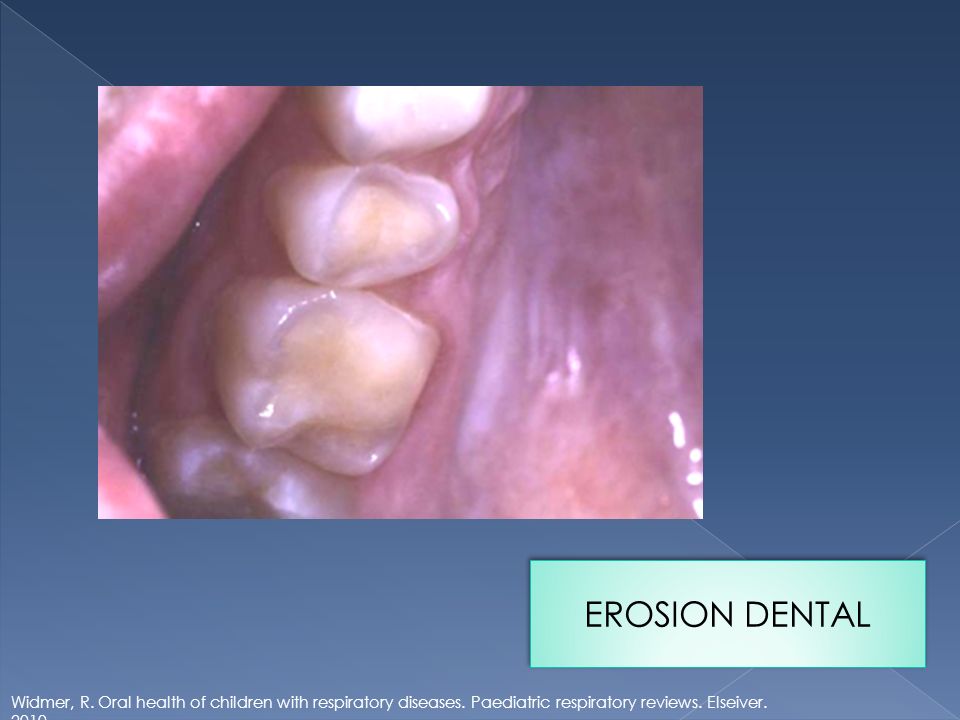 EROSION DENTAL Widmer, R. Oral health of children with respiratory diseases.