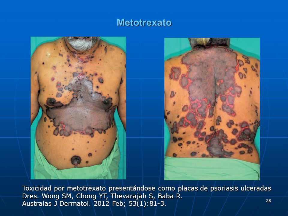 Metotrexato Toxicidad por metotrexato presentándose como placas de psoriasis ulceradas. Dres. Wong SM, Chong YT, Thevarajah S, Baba R.