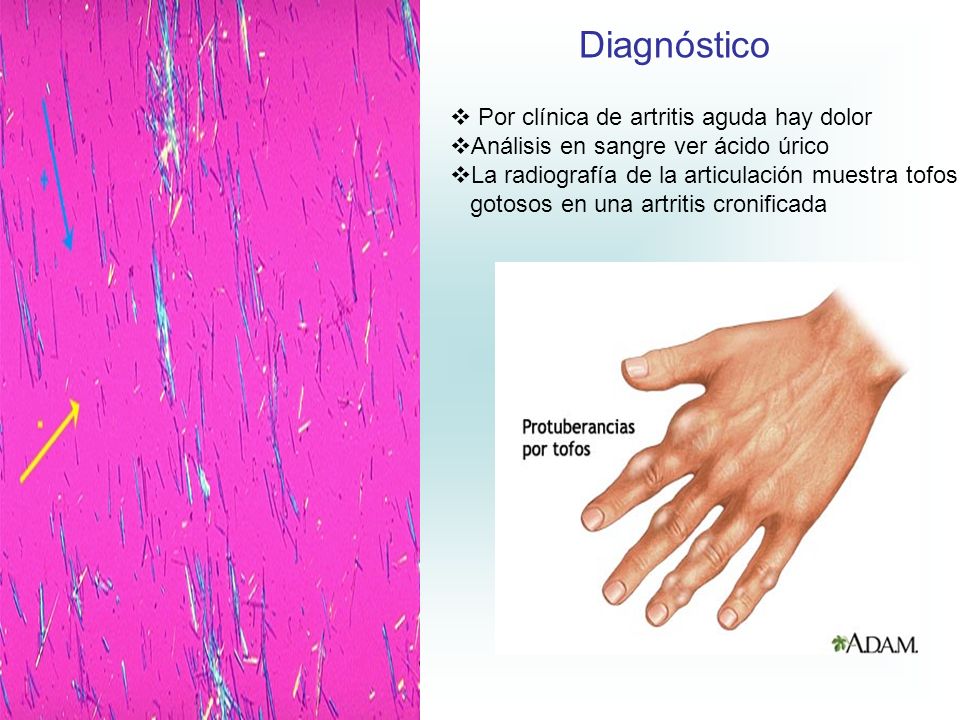 Diagnóstico Por clínica de artritis aguda hay dolor
