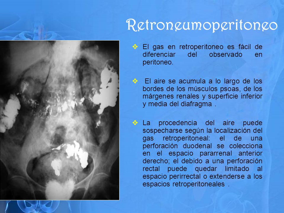 Retroneumoperitoneo El gas en retroperitoneo es fácil de diferenciar del observado en peritoneo.
