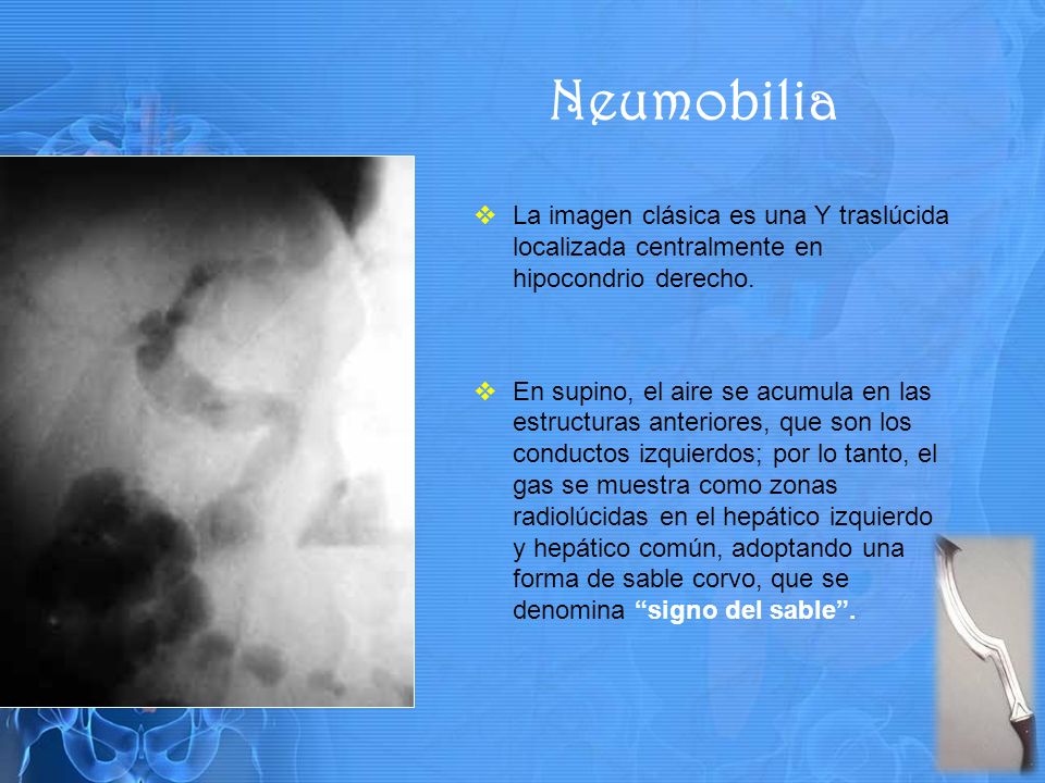 Neumobilia La imagen clásica es una Y traslúcida localizada centralmente en hipocondrio derecho.
