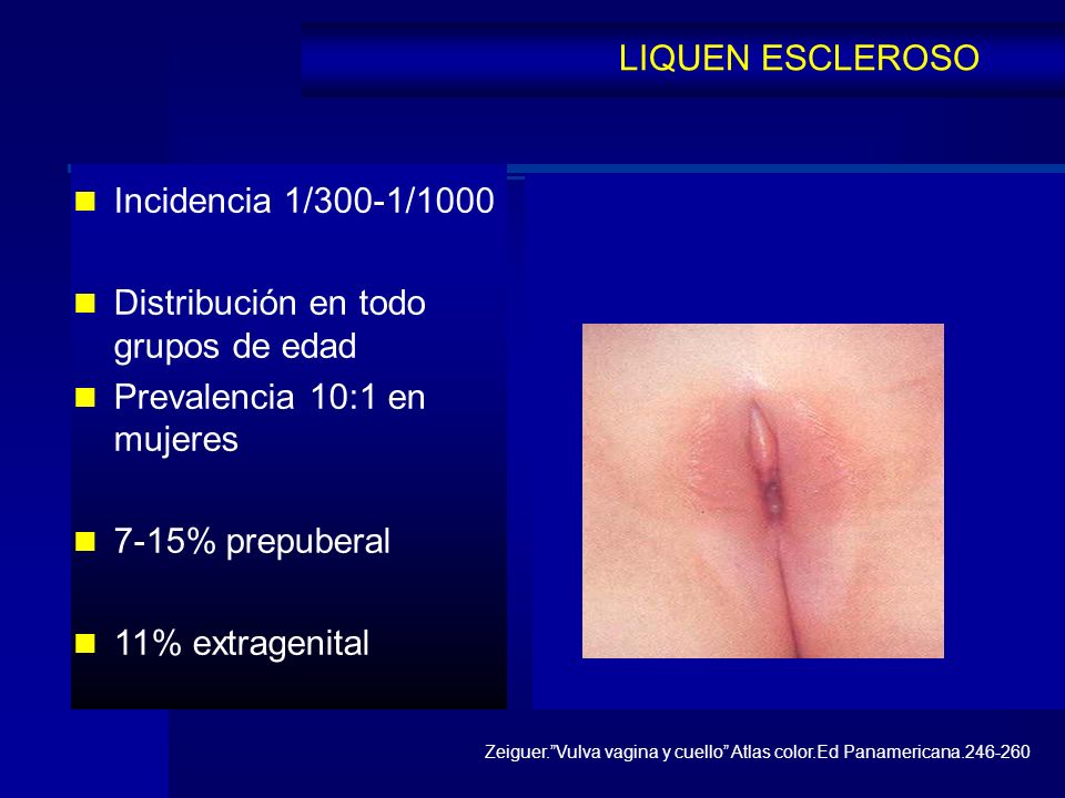 Distribución en todo grupos de edad Prevalencia 10:1 en mujeres