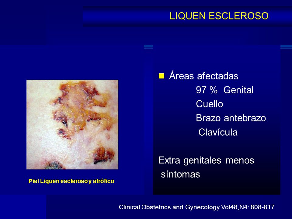 LIQUEN ESCLEROSO Áreas afectadas 97 % Genital Cuello Brazo antebrazo