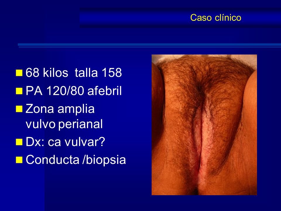 Zona amplia vulvo perianal Dx: ca vulvar Conducta /biopsia