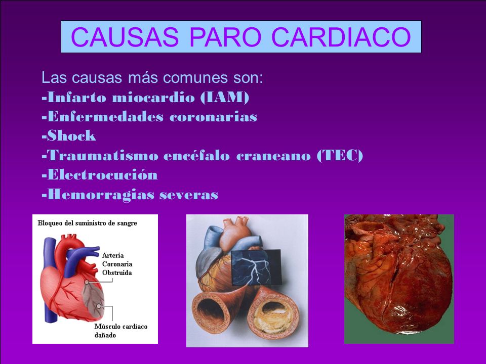 CAUSAS PARO CARDIACO Las causas más comunes son: