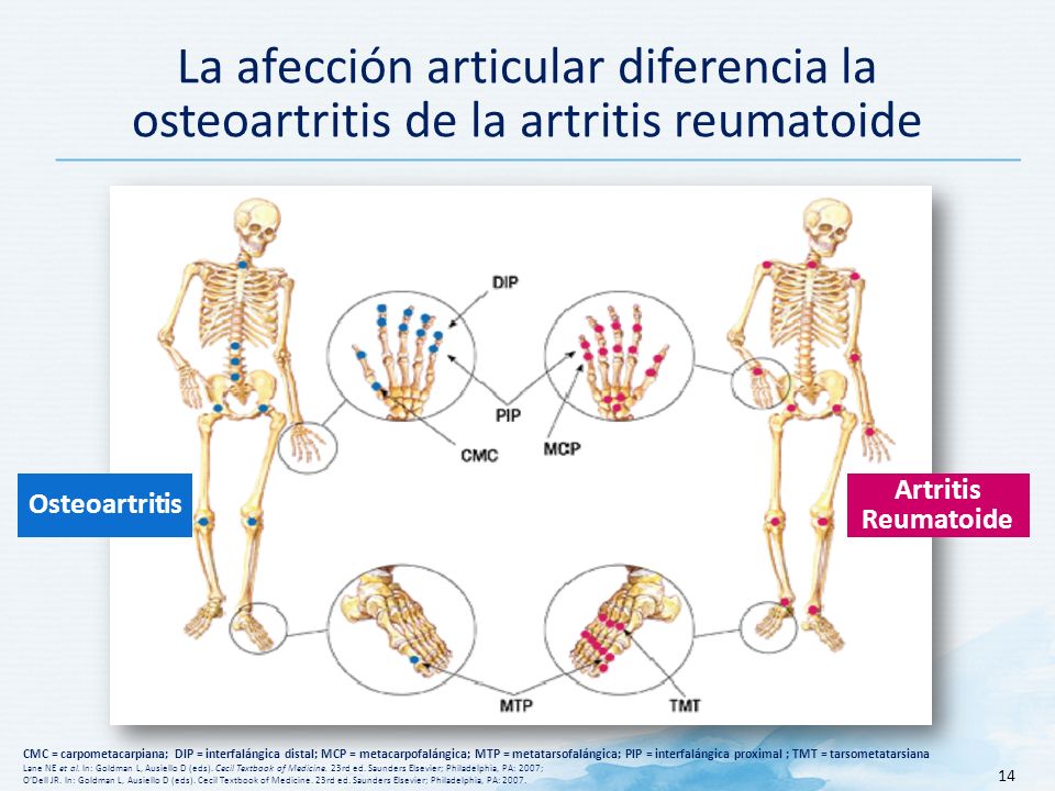 La afección articular diferencia la osteoartritis de la artritis reumatoide