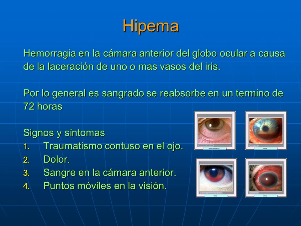 Hipema Hemorragia en la cámara anterior del globo ocular a causa