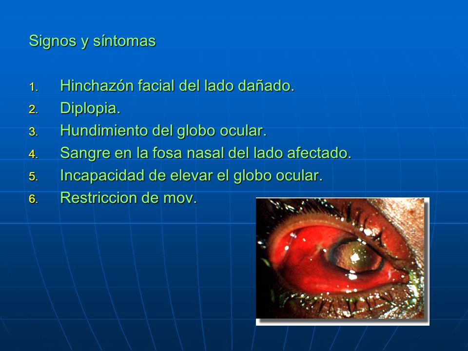 Signos y síntomas Hinchazón facial del lado dañado. Diplopia. Hundimiento del globo ocular. Sangre en la fosa nasal del lado afectado.