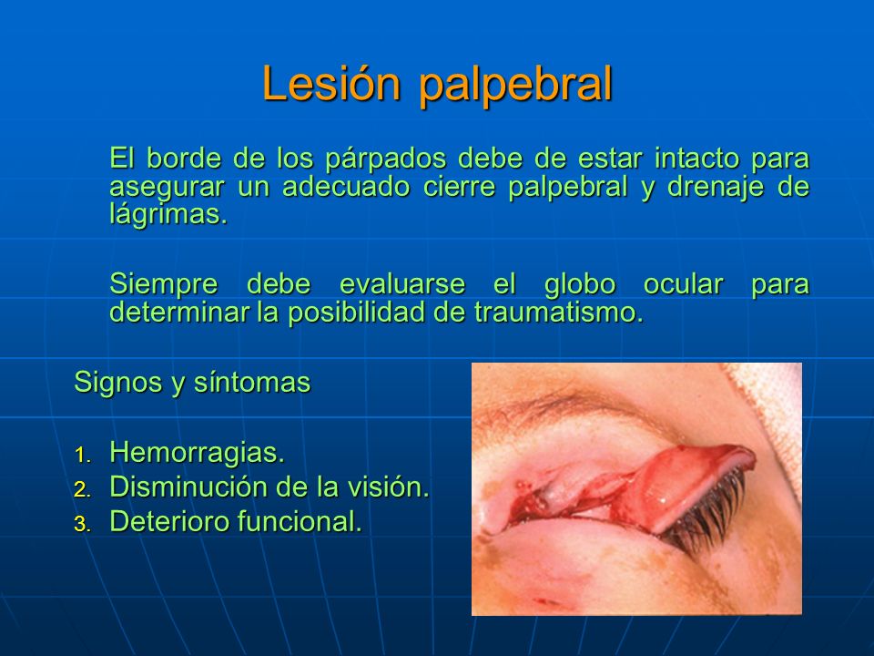 Lesión palpebral El borde de los párpados debe de estar intacto para asegurar un adecuado cierre palpebral y drenaje de lágrimas.