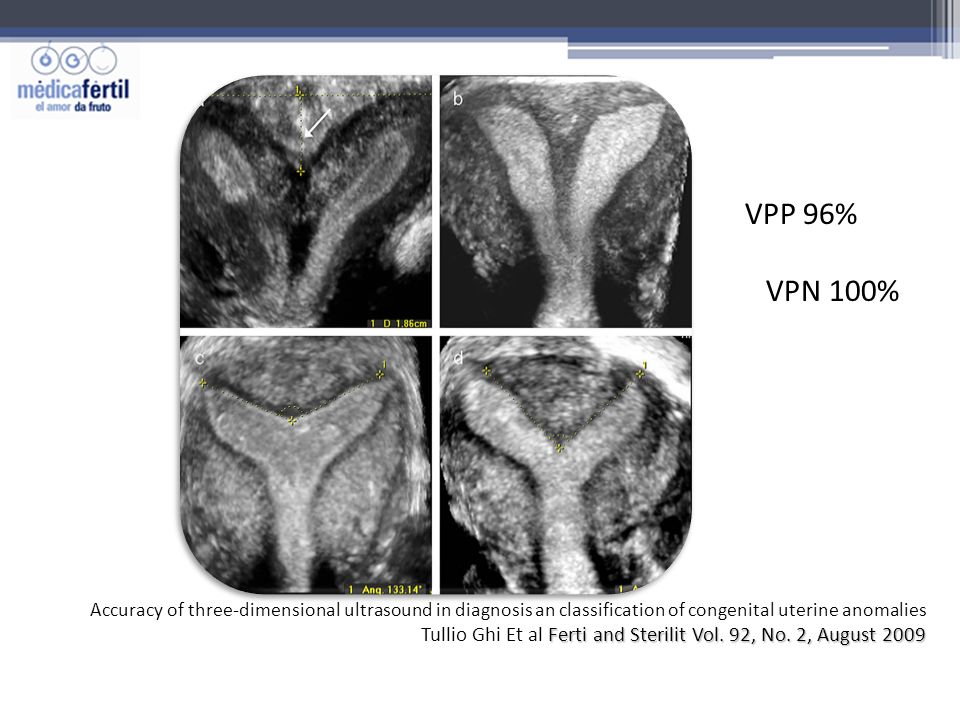 VPP 96% VPN 100% Accuracy of three-dimensional ultrasound in diagnosis an classification of congenital uterine anomalies.