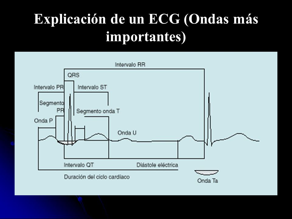Explicación de un ECG (Ondas más importantes)