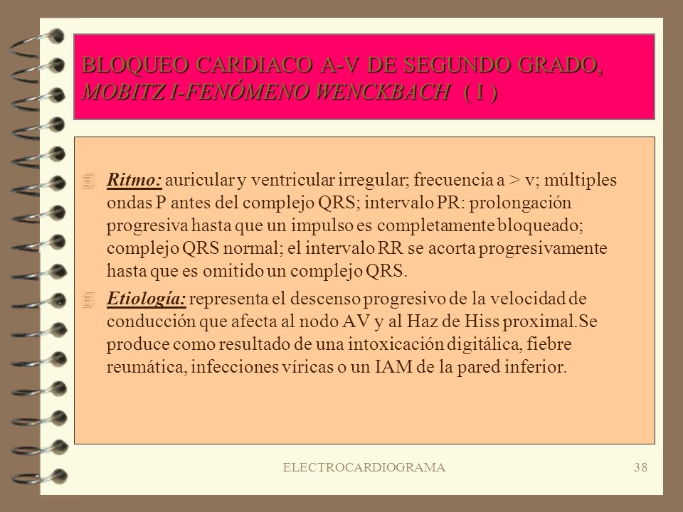 BLOQUEO CARDIACO A-V DE SEGUNDO GRADO, MOBITZ I-FENÓMENO WENCKBACH ( I )