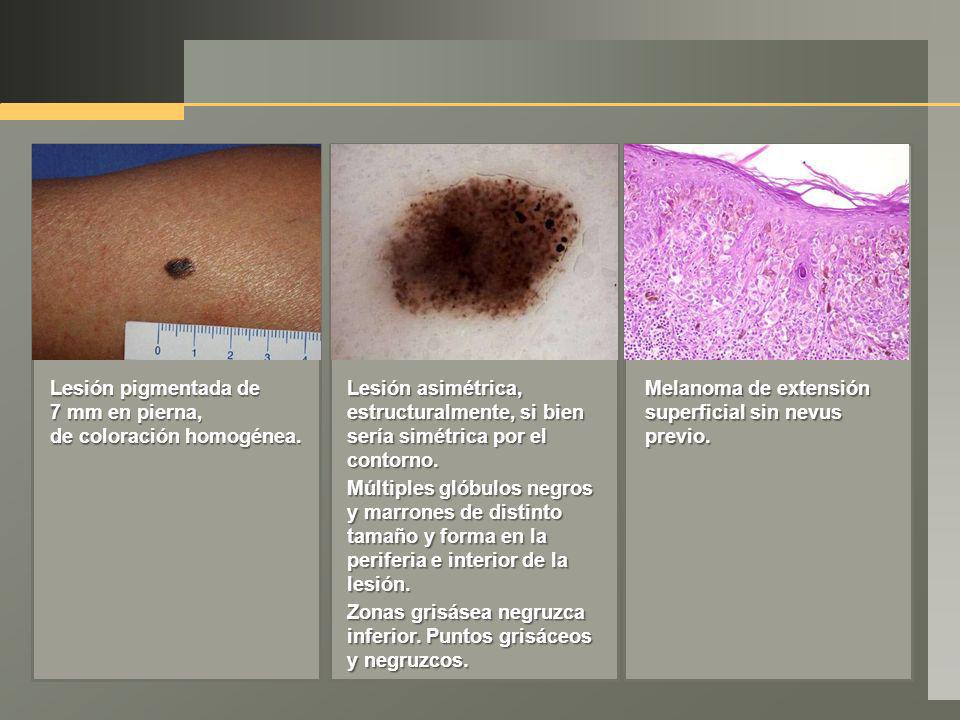 Lesión pigmentada de 7 mm en pierna, de coloración homogénea. Lesión asimétrica, estructuralmente, si bien sería simétrica por el contorno.