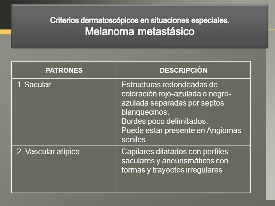 Bordes poco delimitados. Puede estar presente en Angiomas seniles.