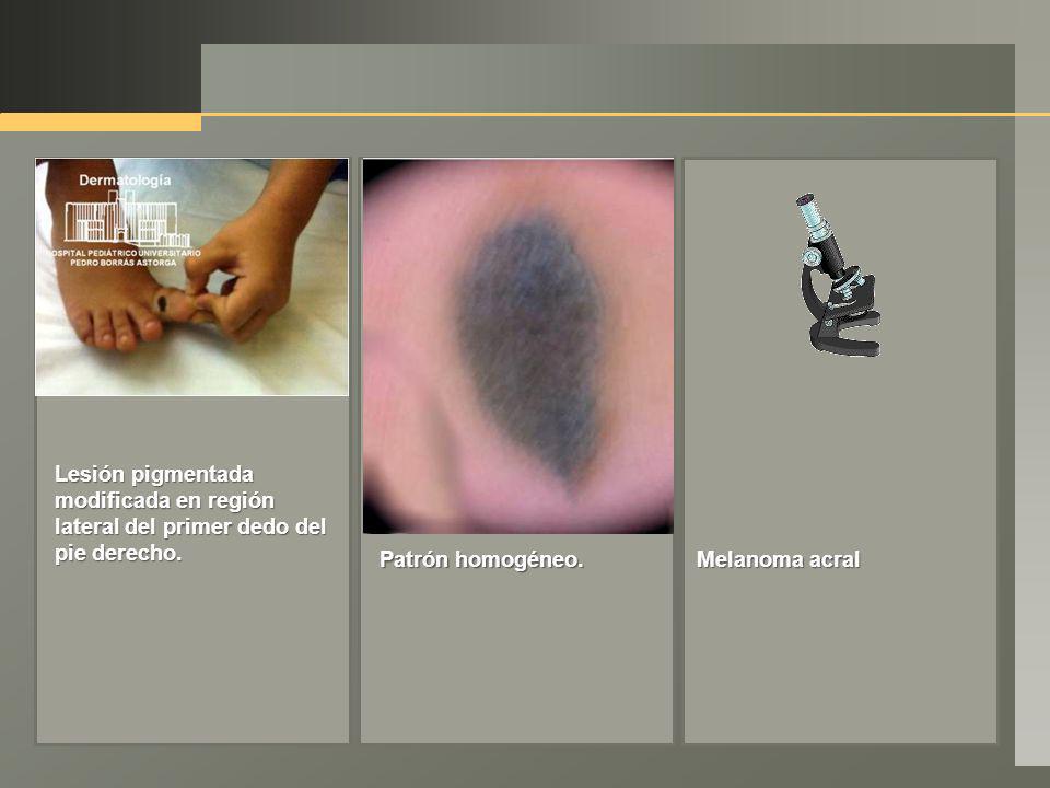 Lesión pigmentada modificada en región lateral del primer dedo del pie derecho.