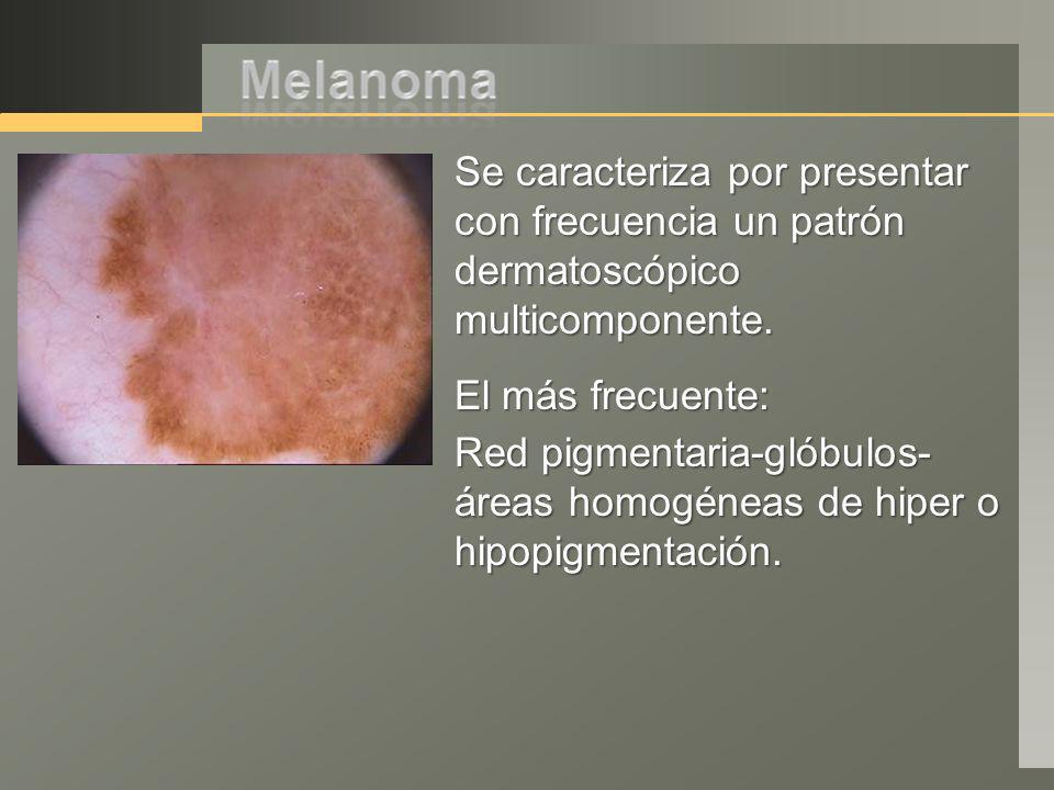 Se caracteriza por presentar con frecuencia un patrón dermatoscópico multicomponente.