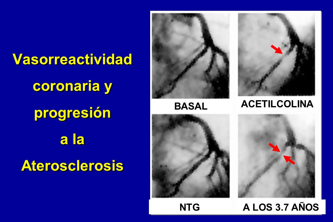 Vasorreactividad coronaria y progresión a la Aterosclerosis