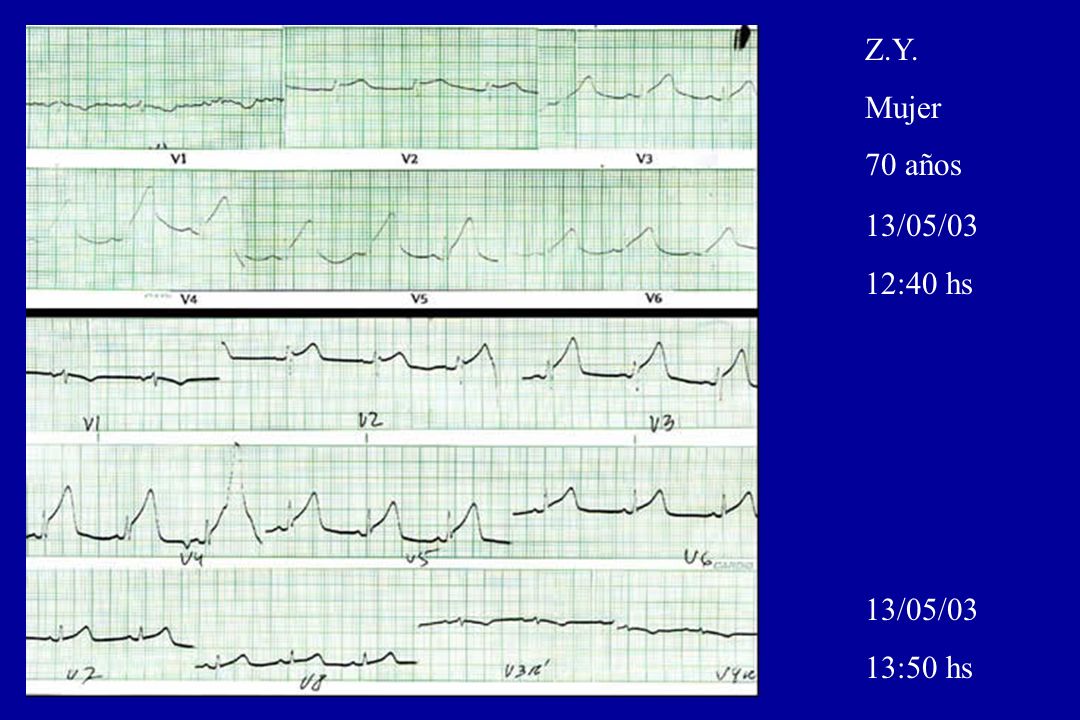 Z.Y. Mujer 70 años 13/05/03 12:40 hs 13/05/03 13:50 hs