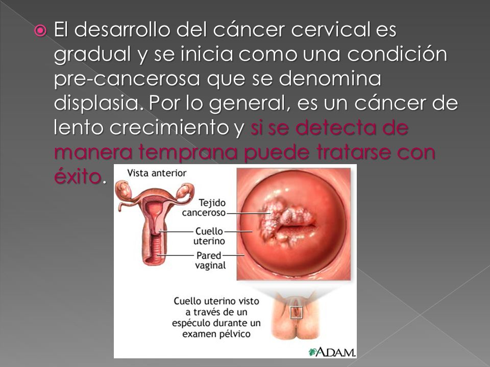 El desarrollo del cáncer cervical es gradual y se inicia como una condición pre-cancerosa que se denomina displasia.
