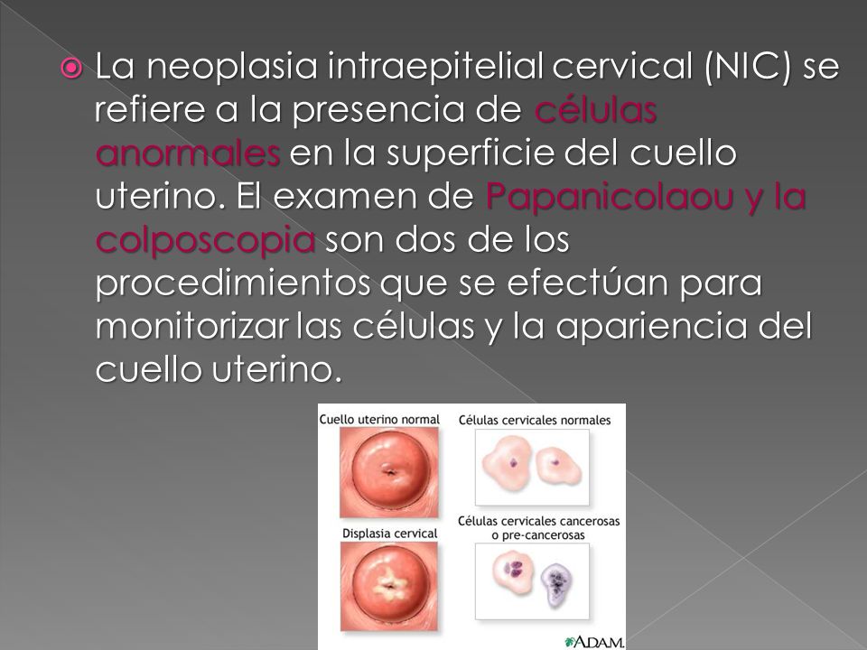 La neoplasia intraepitelial cervical (NIC) se refiere a la presencia de células anormales en la superficie del cuello uterino.