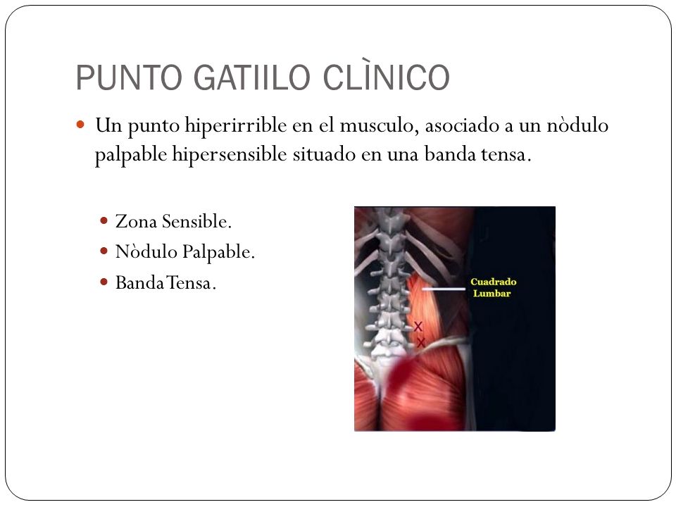 PUNTO GATIILO CLÌNICO Un punto hiperirrible en el musculo, asociado a un nòdulo palpable hipersensible situado en una banda tensa.