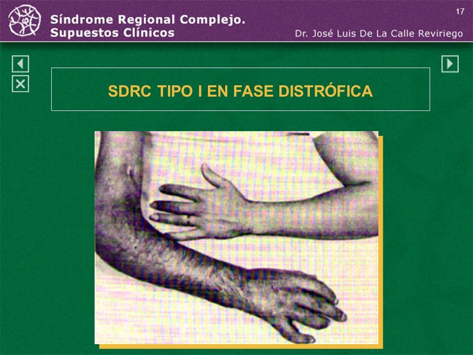 SDRC TIPO I EN FASE DISTRÓFICA
