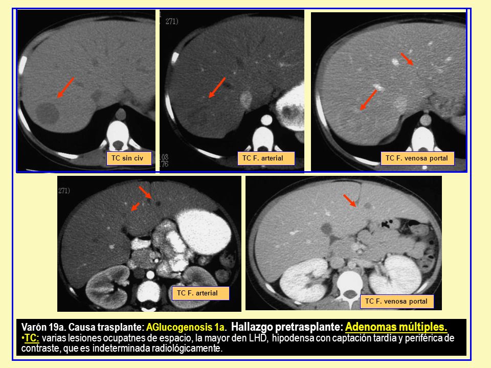 TC sin civ TC F. arterial. TC F. venosa portal. TC F. arterial. TC F. venosa portal.
