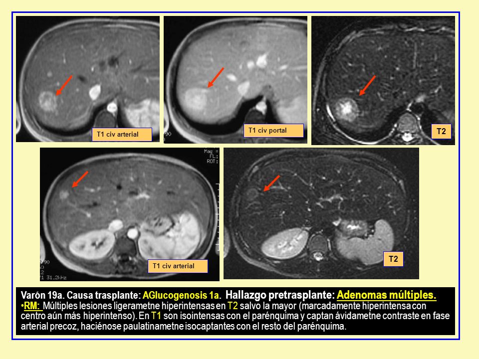 T1 civ portal T2. T1 civ arterial. T2. T1 civ arterial.