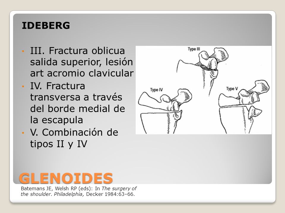 IDEBERG III. Fractura oblicua salida superior, lesión art acromio clavicular. IV. Fractura transversa a través del borde medial de la escapula.