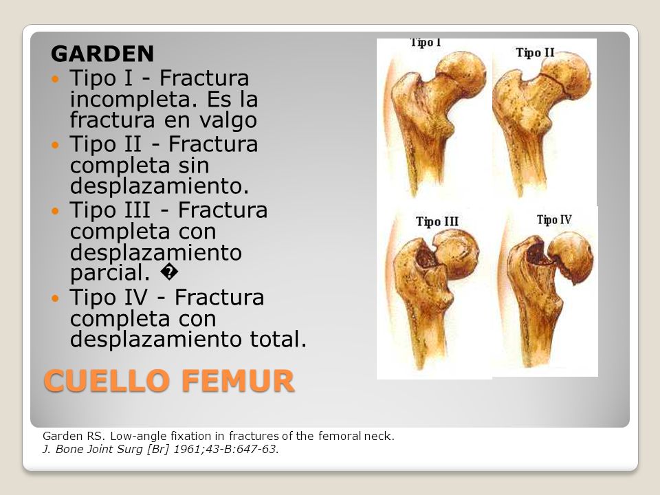 GARDEN Tipo I - Fractura incompleta. Es la fractura en valgo. Tipo II - Fractura completa sin desplazamiento.
