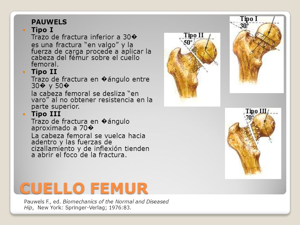 CUELLO FEMUR PAUWELS Tipo I Trazo de fractura inferior a 30�