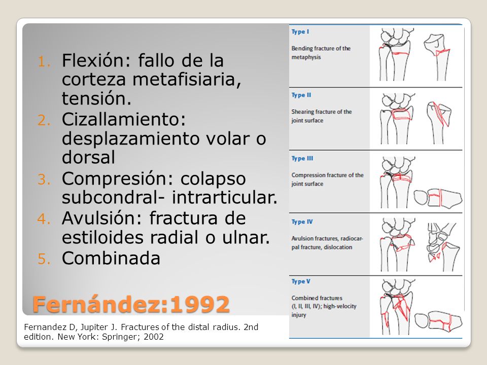 Fernández:1992 Flexión: fallo de la corteza metafisiaria, tensión.