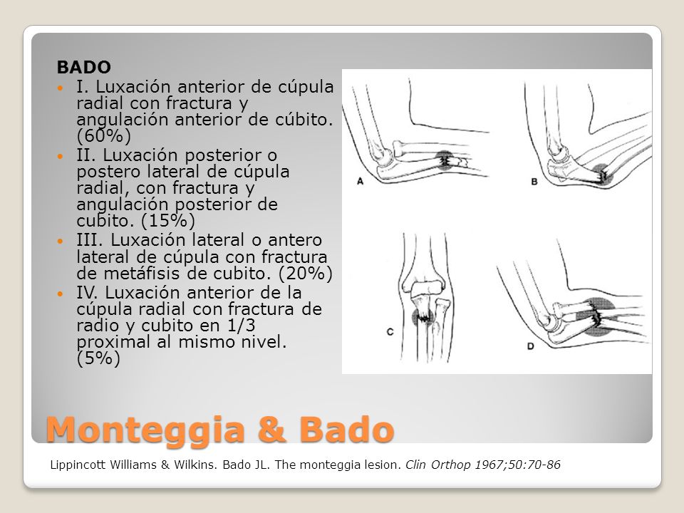 BADO I. Luxación anterior de cúpula radial con fractura y angulación anterior de cúbito. (60%)