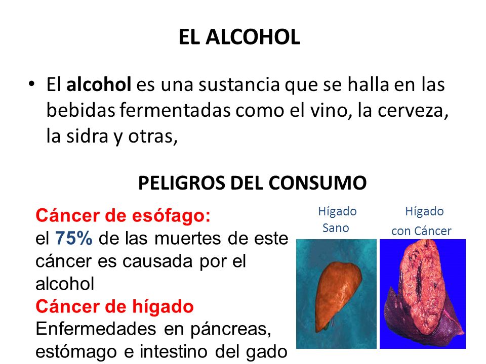 Hígado con Cáncer EL ALCOHOL