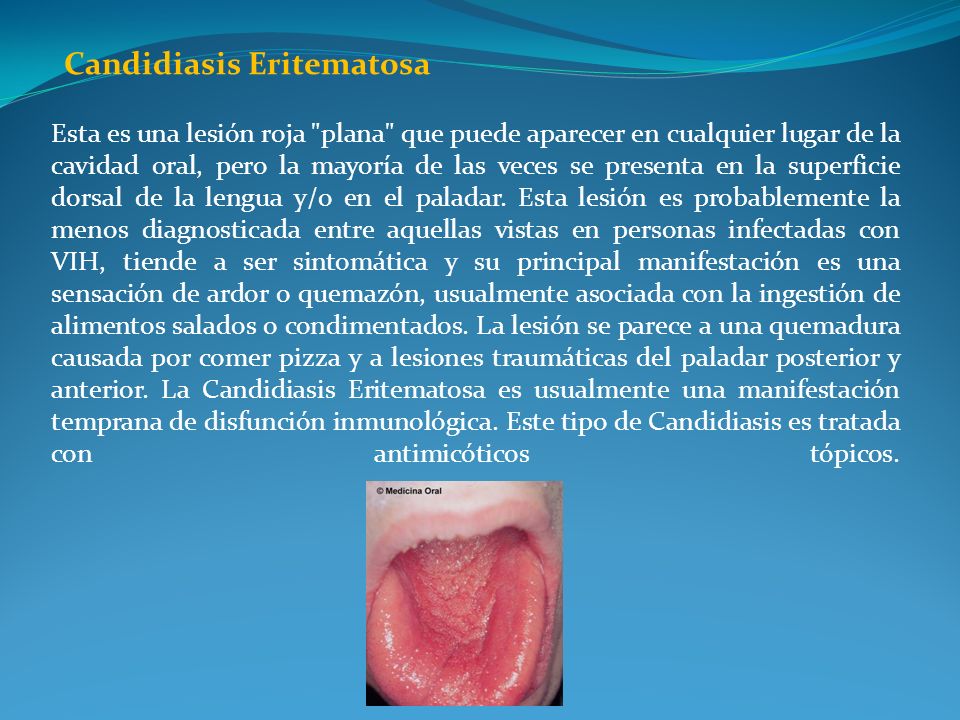 Candidiasis Eritematosa