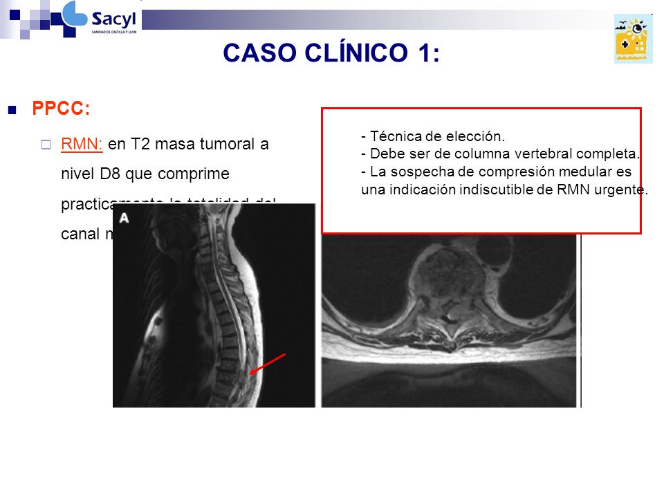 CASO CLÍNICO 1: PPCC: RMN: en T2 masa tumoral a nivel D8 que comprime practicamente la totalidad del canal medular.