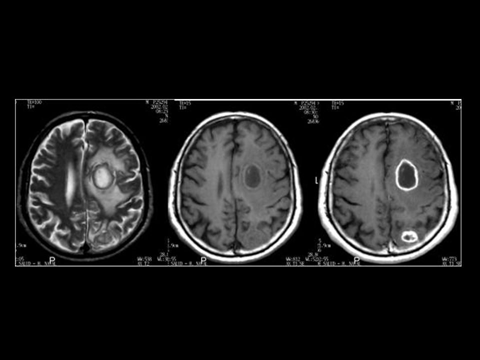 25294 TBC Cerebral 25294_tbc_cere_002.jpg 25294_tbc_cere_006.jpg