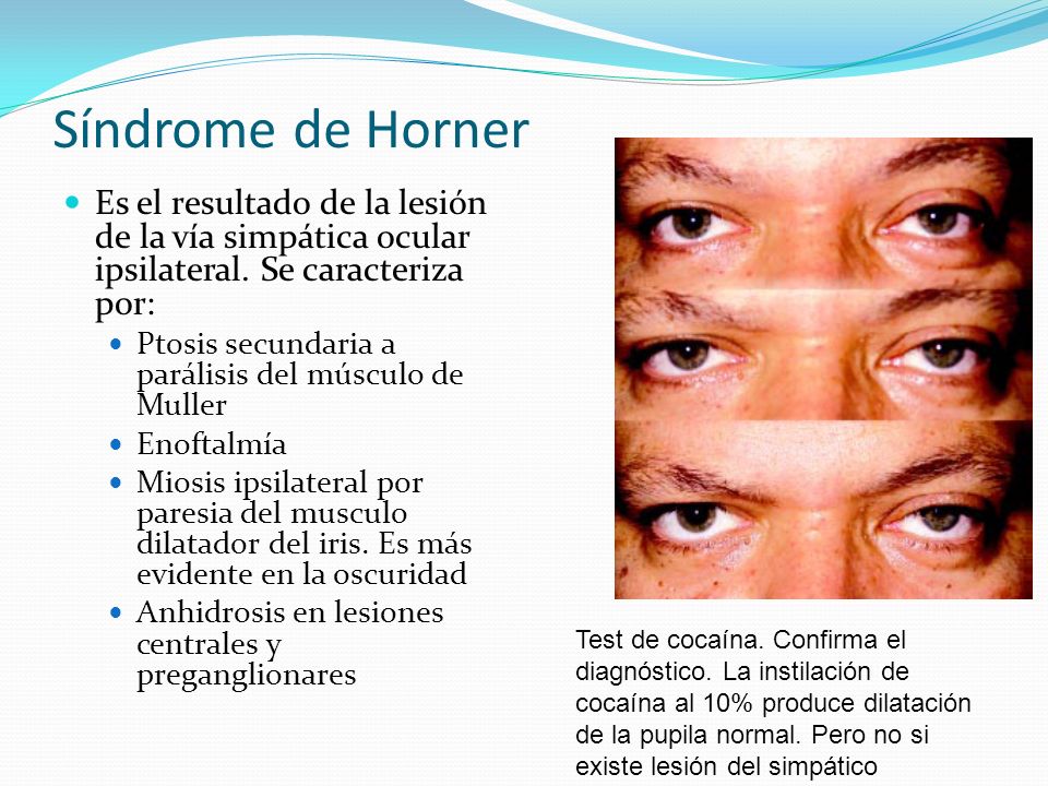 Síndrome de Horner Es el resultado de la lesión de la vía simpática ocular ipsilateral. Se caracteriza por: