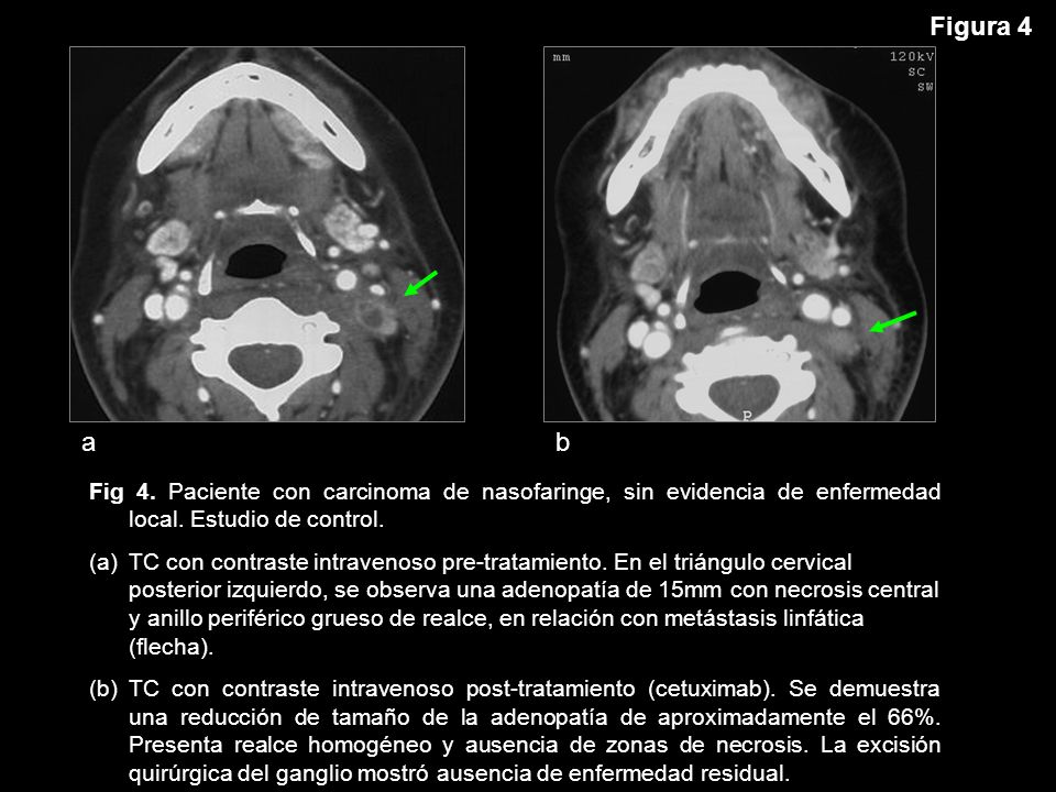 Figura 4 a. b. Fig 4. Paciente con carcinoma de nasofaringe, sin evidencia de enfermedad local. Estudio de control.